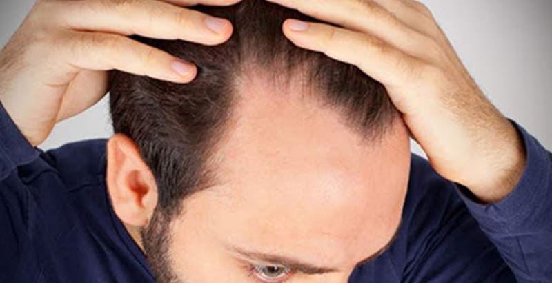 caída del pelo relacionada con el estrés