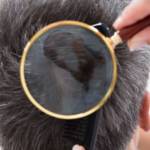 Causas de la caída del cabello en hombres