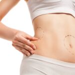 Lipo Vaser High Definitión: Cómo definir tus músculos y lucir un físico más atlético