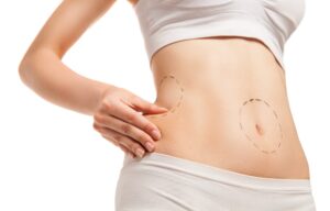Lipo Vaser High Definitión: Cómo definir tus músculos y lucir un físico más atlético