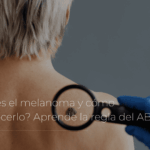 ¿Qué es el melanoma y cómo reconocerlo? Aprende la regla del ABCDE