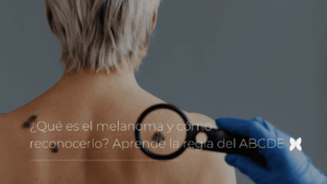 ¿Qué es el melanoma y cómo reconocerlo? Aprende la regla del ABCDE