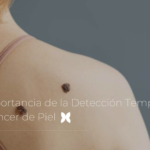 La Importancia de la Detección Temprana del Cáncer de Piel