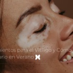Tratamientos para el Vitíligo y Cómo Manejarlo en Verano